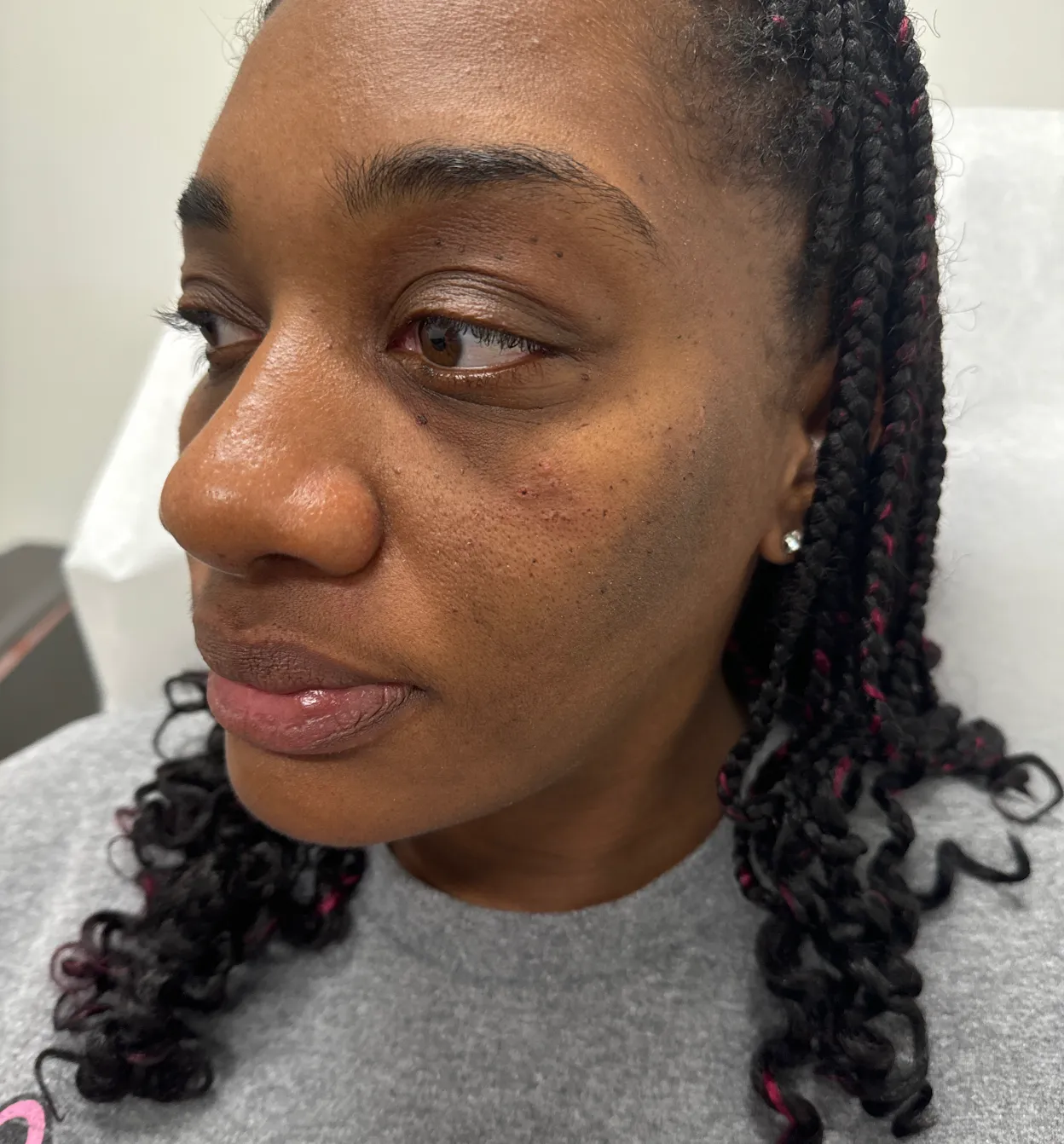 After Dermatosis Papulosa Nigra Treatment Image