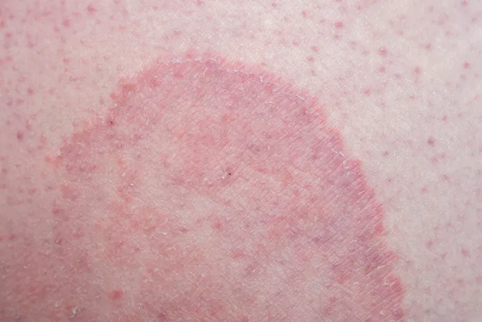 Close up of skin affected by jock itch