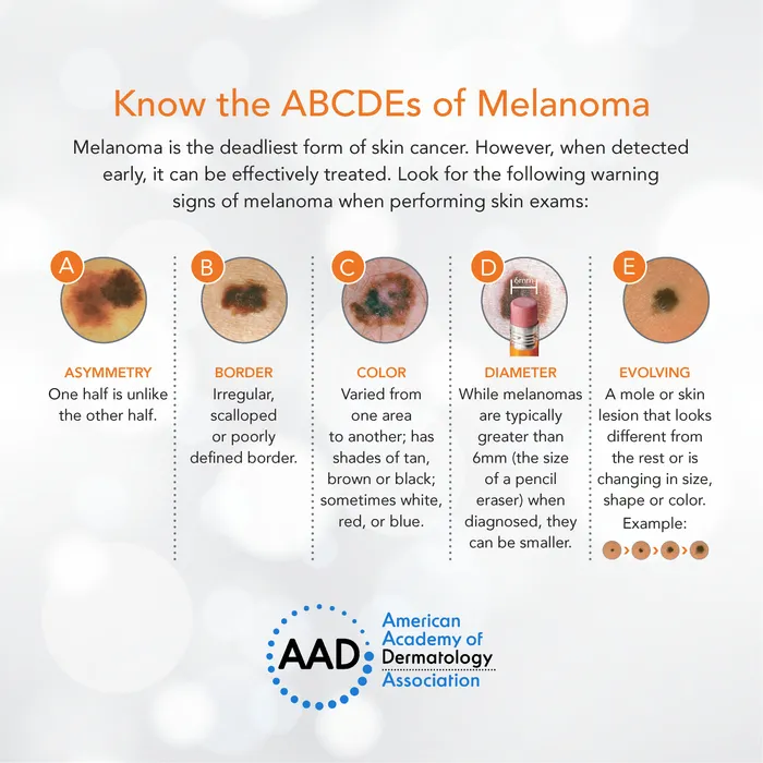 Image about how to recognize melanoma
