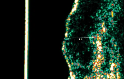 Ultrasound mid-way through GentleCure treatment